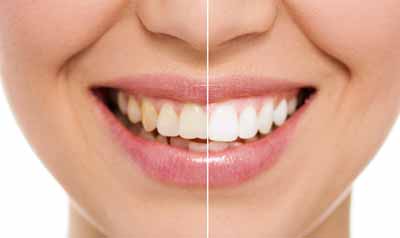 reliable and easy teeth whitening